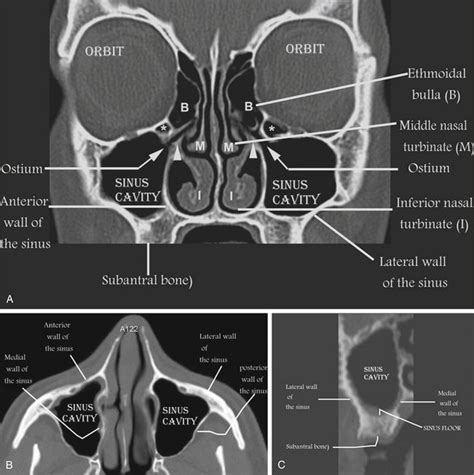 Maxillary Bone Anatomy Ct