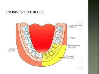 Mandibular nerve blocks techniques | PPT