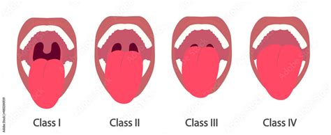 Mallampati Score. Assessment to predict the difficulty of airway ...