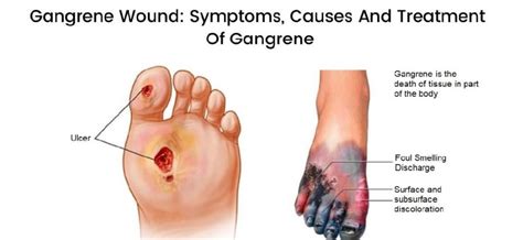 Gangrene – types, causes, symptoms. Gangrene treatment methods ...