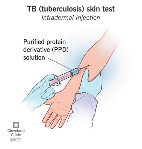 TB Test: What It Is, How It Works, Results & Side Effects