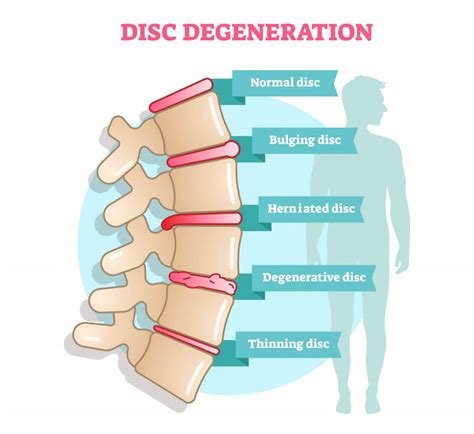 Bulging Discs vs. Herniated Discs - Advanced Chiropractic Spine ...