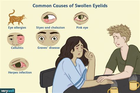 Why Is My Eyelid Swollen – Austra Health