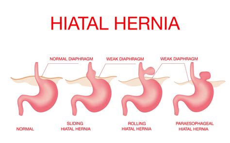 Hiatal Hernia - Dubai Hernia Surgery Clinic DRHC