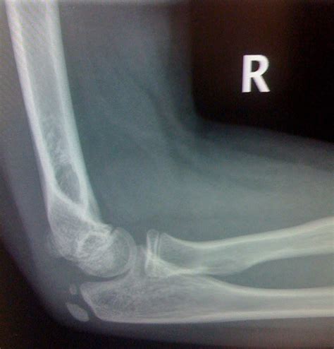 pediatric elbow x-ray | ALiEM