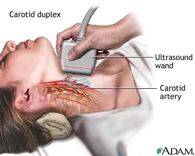 Carotid duplex: MedlinePlus Medical Encyclopedia Image