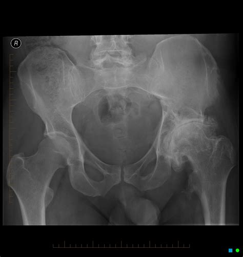 Endstage degenerative arthritis of the hip | Image | Radiopaedia.org