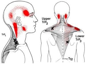 The Definitive Guide to Upper Trapezius Anatomy, Exercises & Rehab