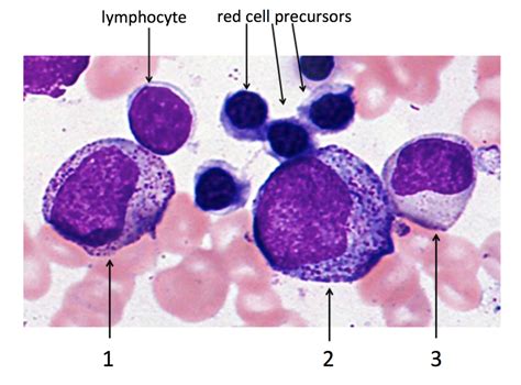 How to tell apart promyelocytes and myelocytes | Pathology Student