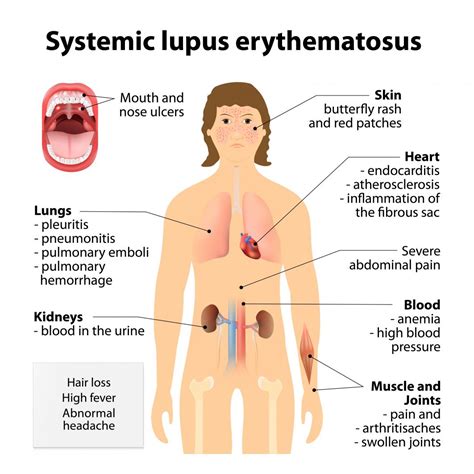 Systemic lupus erythematosus: Symptoms and treatments