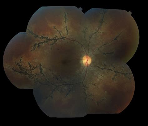 Moran CORE | Pigmented Paravenous Retinochoroidal Atrophy