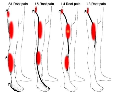 Sciatica? Similar Symptoms, Different Causes - StudyPK