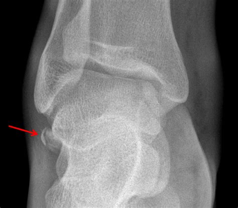 Dorsal Talar Avulsion Fracture