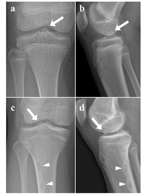 Tibial Plateau Avulsion Fracture