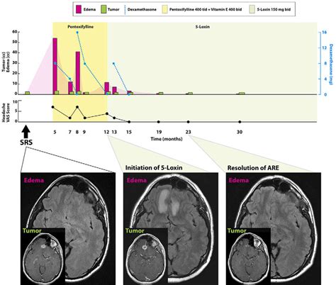 Case 1. Timeline of symptoms, imaging findings, and steroid dose ...