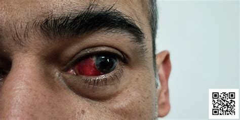 A Broken Blood Vessel in Your Eye — What You Can Do | Dialect Zone ...