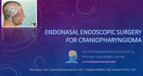 Endoscopic Craniopharyngioma Tumor Surgery | Pituitary Disorders Center