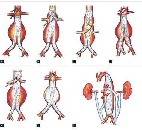 Endovascular Aortic Aneurysm Repair (EVAR): Risks Benefits And ...