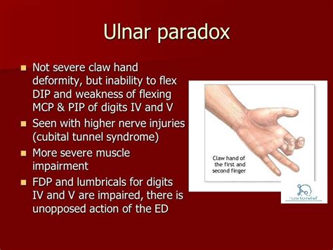 Claw Hand & Ulnar Paradox » How To Relief | Hand therapy, Ulnar nerve ...