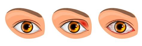 Viral Eye Infection: Types, Symptoms, Treatment | STD.GOV Blog