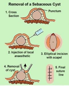 Sebaceous Cyst (Epidermal Cyst) - Pictures, Causes, Treatment and Removal