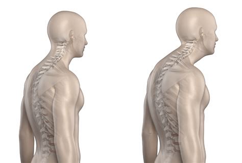 Thoracic Kyphosis Types, Causes, Symptoms, Treatment