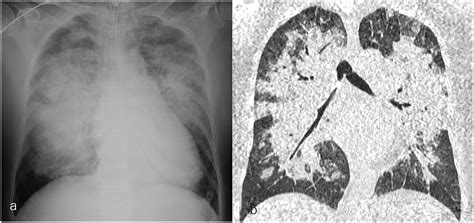 Pulmonary Edema Chest X Ray