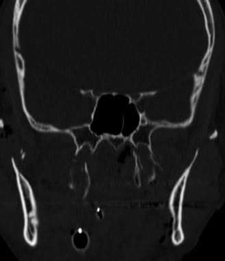 Pterygoid Plate Fracture