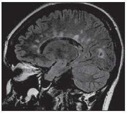 My Radiology Files: “Dawson’s fingers” in multiple sclerosis