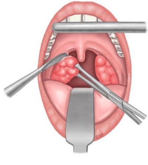 Tonsillectomy Scabs – All You Need To Know (2023)