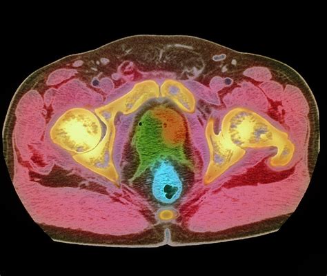 Coloured Mri Scan Showing Prostate Cancer Photograph by Science Photo ...