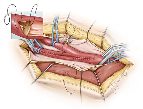 Carotid Endarterectomy | The Neurosurgical Atlas