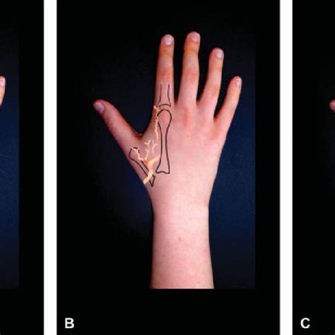 The three different patterns of the first dorsal metacarpal artery ...