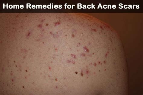 Severe acne scars on back