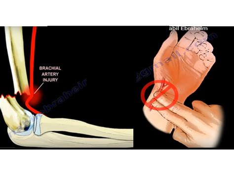 Vascular Injury in Supracondylar Humerus Fractures ...