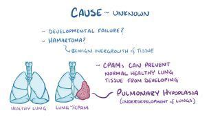 Tension Pneumothorax: What Is It, Causes, Signs, Symptoms, Diagnosis ...