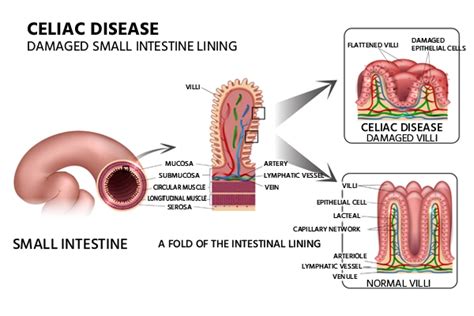 Celiac disease - NabahaKatalina