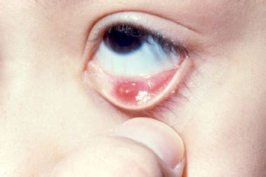 Chalazion - Kensington Ophthalmology - Brighton MI