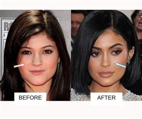 Kylie Jenner Plastic Surgery: Before And After Images - 2022 | Fabbon