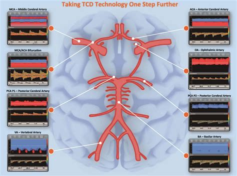 Transcranial Doppler is a Standard Reimbursable Procedure