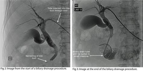 Percutaneous Transhepatic Biliary Drainage (Ptbd)