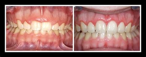 Gingivoplasty, Dental Treatment Services - Dr. Sachdevas Dental ...