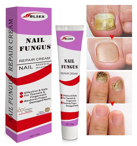 Foot Fungus Treatment Extra Strength with Miconazole, Undecylenic Acid ...