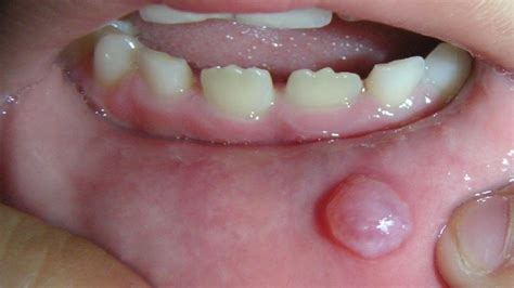 Mucocele | The Dental Arcade – Blog