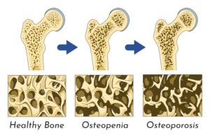 Osteopenia vs Osteoporosis | AllSpine