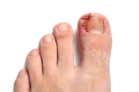 Ouch! How To Fix Ingrown Toenails Now – My FootDr