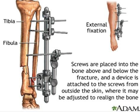 External fixator | Med surg nursing, Medical school studying, Medical ...