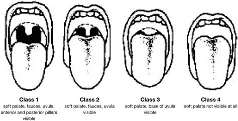 Mallampati classification, class and scale