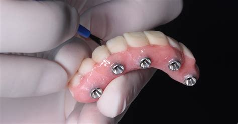 All-on-4 Dental Implants Are A Trusted Dental Implant System