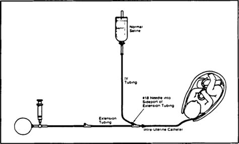 Amnioinfusion: A Technique for the Relief of Variable Deceleration ...